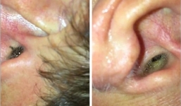 Kinh hoàng nhện chui vào tai người làm tổ giăng tơ