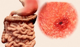 7 triệu chứng ung thư sớm không gây đau: Chỉ cần có 1 triệu chứng là bạn phải đi khám ngay