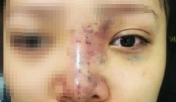 Tiêm filler nâng mũi, nữ sinh viên 20 tuổi ở Sài Gòn đối diện nguy cơ hoại tử da, mù mắt vĩnh viễn