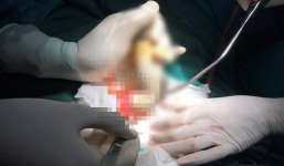 Hi hữu: Thiếu niên dùng ống xịt hơi bằng nhựa xịt vào hậu môn khiến 1 người bị vỡ ruột