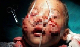 Bé trai 4 tuổi bị chó cắn trọng thương ở cổ