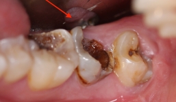 Chuyện gì sẽ xảy ra nếu bạn có một chiếc răng sâu và không chịu chữa trị ngay?