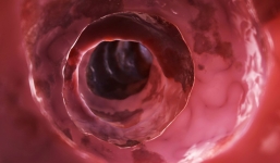 5 dấu hiệu điển hình cảnh báo khối u ung thư đại trực tràng đang phát triển 'thần tốc'