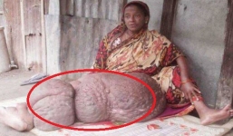 Chân bị biến dạng nặng gần 60 kg khiến người phụ nữ không thể cử động suốt 18 năm