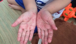 Trước dịch bệnh tay chân miệng nguy hiểm, cha mẹ không được quên việc này