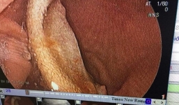 'Ngáo cỏ Mỹ' nam thanh niên cắn lìa tai bạn và nuốt vào bụng