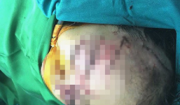 Bé 31 tháng tuổi bị chó nhà cắn biến dạng khuôn mặt