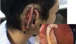 Công an vào cuộc vụ nam sinh cắn đứt tai bạn rồi nuốt luôn vào bụng