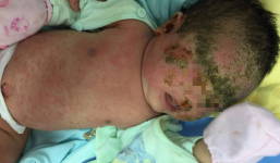Bé sơ sinh viêm da chảy mủ toàn thân vì tắm nước lá chữa mụn nhọt