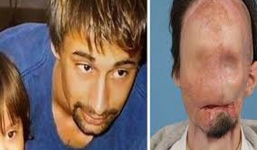 Bị điện giật mất cả khuôn mặt, con gái hốt hoảng không nhận ra cha nhưng 10 năm sau ai cũng bất ngờ khi gặp lại người đàn ông ấy