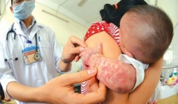 Dịch chân tay miệng, sởi và sốt xuất huyết cùng tấn công, Bộ Y tế chỉ đạo khẩn