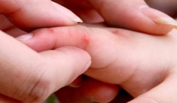 Hơn 60.000 ca mắc tay chân miệng, nguy cơ dịch chồng dịch