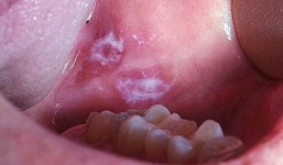 Cảnh báo: Sống ở các thành phố đầy khói bụi làm tăng nguy cơ ung thư miệng lên tới 40\%