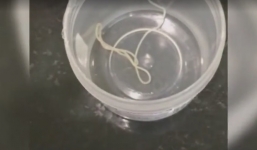 Rùng mình cảnh gắp con sán ký sinh trong mắt người đàn ông