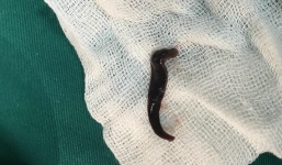 Uống nước suối, người phụ nữ nhập viện nguy kịch vì bị con vắt chui vào mũi