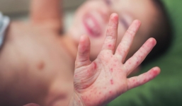 Thêm một trường hợp bé 17 tháng tử vong vì tay chân miệng