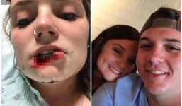 Cắn đứt môi bạn gái cũ vì không chịu quay lại, chàng trai bị tuyên án 12 năm tù