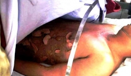 Kinh hoàng nam thanh niên cháy nửa người khi đổ xăng lẻ ven đường