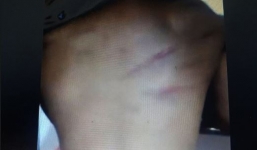 Cô giáo đánh bầm lưng học sinh lớp 1 vì không làm bài tập: Là người sống có tâm và được phụ huynh yêu mến