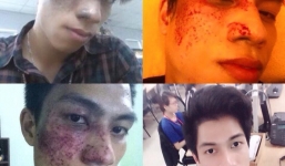 Không xin được việc vì vết chàm lớn trên gương mặt, thanh niên quyết tâm 'lột xác' diện mạo và cái kết