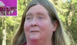 Hóa trang Halloween, người phụ nữ bị kẹt răng giả trong miệng 2 ngày