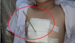 Bé lớp 2 nguy kịch vì bị bạn đâm cây xiên cá viên chiên thấu ngực