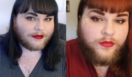 Cô gái có râu rậm như đàn ông ở Mỹ chấp nhận hiện thực, dần lấy lại tự tin