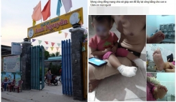 Bảo mẫu sơ ý mở nhầm nước nóng khiến bé gái 18 tháng tuổi bị bỏng hai chân