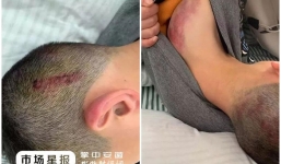 Đi học trễ hai phút, nam sinh bị giáo viên dùng liên tục 4 cây chổi đánh nhập viện