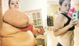 Hy hữu: Cô gái phải cắt bỏ 3kg da thừa sau khi giảm 141kg trong 2 năm