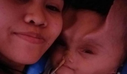 Hy hữu: Bé trai 1 tuổi mang 'cặp sừng quỷ dữ' sau ca phẫu thuật bất thành