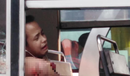 Nam thanh niên mất cánh tay sau một giấc ngủ trên xe buýt vì lý do rùng mình