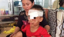Bé trai 6 tuổi bị chó nhà cắn nát vùng mặt