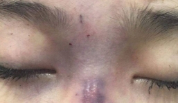 Chồng tự đi học, tiêm filler vào mũi cô vợ trẻ khiến vợ mù vĩnh viễn