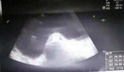 Sự thật đáng sợ phía sau bức ảnh siêm âm 'người mang thai cá'