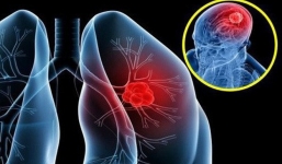 Tưởng viêm phổi lại hoá ung thư giai đoạn 4, người phụ nữ cảnh báo về 1 dấu hiệu cần chú ý