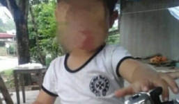 Vụ bé trai 5 tuổi tử vong bất thường sau khi cắt amidan: Hé lộ nguyên nhân