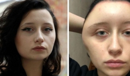 Cô gái xinh đẹp bàng hoàng thấy khuôn mặt mình bị biến dạng sau một đêm, nguyên nhân không ngờ tới