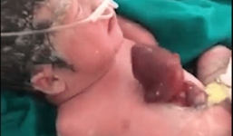 Nín thở nhìn trái tim bé sơ sinh đập từng nhịp ngoài lồng ngực