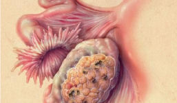 Căn bệnh nguy hiểm quá nửa số người mắc không sống được 5 năm: Cảnh giác với dấu hiệu này