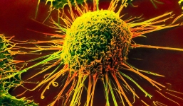 Ung thư cũng biết 'chọn mặt gửi mầm bệnh' với 8 nhóm người: Ai cũng nên xem để phòng tránh