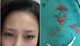 Cô gái trẻ phải tháo độn cằm vì biến chứng do tiêm chất làm đầy từ 4 năm trước: 'Mình vẫn đang băng nẹp, không biết tháo ra sẽ thế nào...'