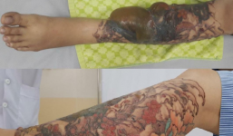 Bị bỏng nặng khi xóa hình xăm bằng laser, cô gái khóc ngất vì không nhận ra 2 chân của mình