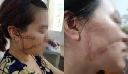 Tuyên án gã chồng 'hờ' cuồng ghen cắt gân chân, rạch mặt vợ dã man