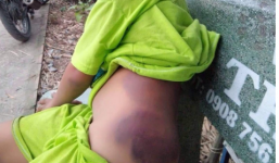 Long An: Học sinh tố bị cô giáo đánh bầm tím sườn, mông