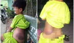 Học sinh lớp 1 bị bầm tím người, nghi bị cô giáo đánh tại trường