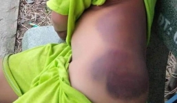 Đình chỉ công tác 15 ngày giáo viên đánh học sinh bầm tím người