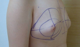 Chàng trai bất ngờ có vòng 1 nảy nở to bất thường vì dùng mỹ phẩm dành cho nữ