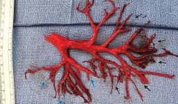 Hy hữu: Bác sĩ hoảng hốt khi bệnh nhân đang điều trị tim thì ho ra cả phổi