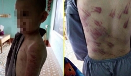 Vụ bé 10 tuổi bị đánh thâm tím người: 'Chỉ là dùng roi dạy dỗ cháu thôi, không có gì to tát'